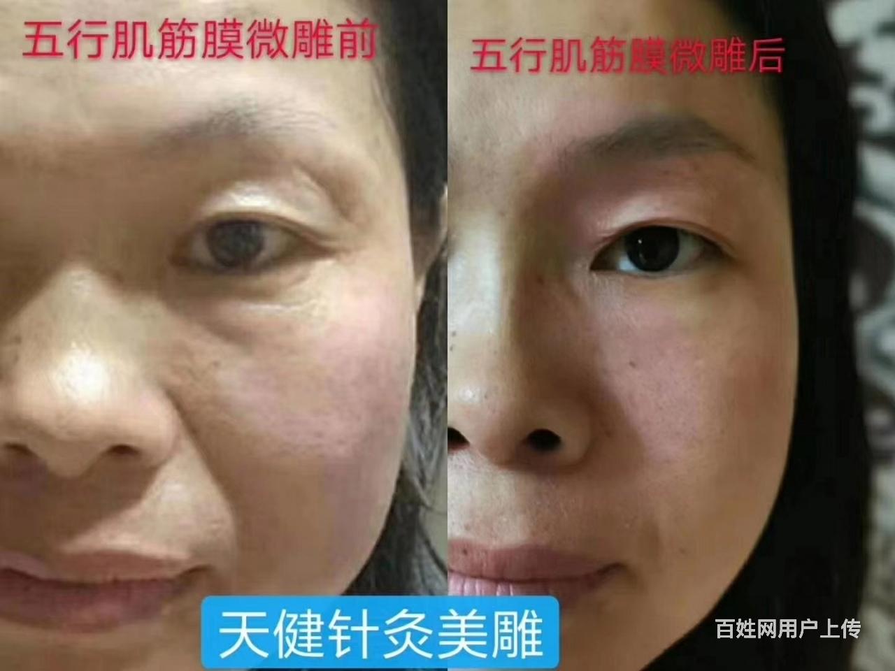营口微雕针灸美雕培训富贵包效果好