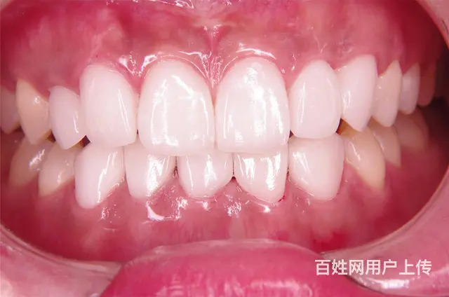 哈尔滨牙齿美白哪里比较好 - 图片 1