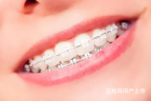 矫正后牙齿反弹不再困扰，这些方法帮你维持美丽笑容 - 图片 2