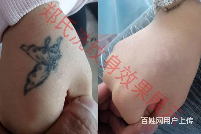 沈阳洗纹身就到辽阳郑氏洗纹身专洗别处洗不掉的纹身 - 图片 7