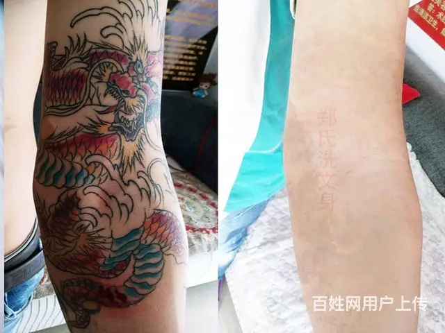纹身要怎么做才能完全洗掉 - 图片 1