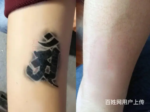 辽阳郑氏洗纹身工作室一次洗掉纹身 - 图片 2