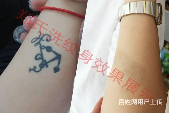 沈阳洗纹身一次性洗纹身签合同包洗所有纹身郑氏洗纹身 - 图片 4