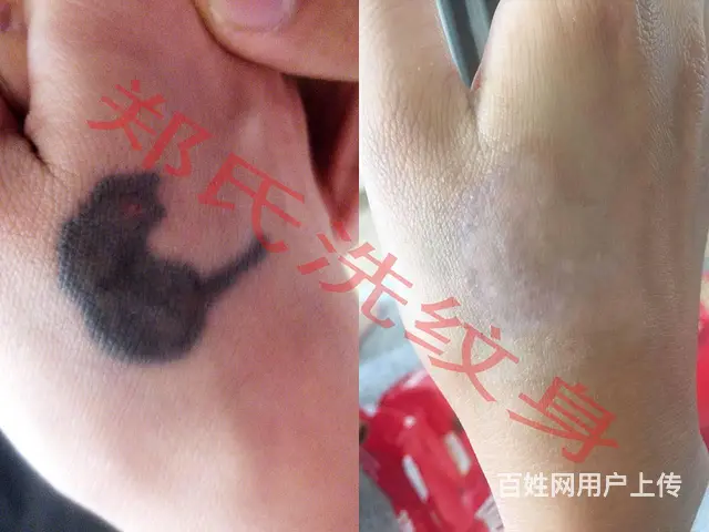 抚顺洗纹身哪家好辽阳郑氏洗纹身包洗干净真可靠 - 图片 4