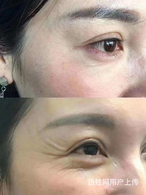 在潍坊打个祛皱针多少钱