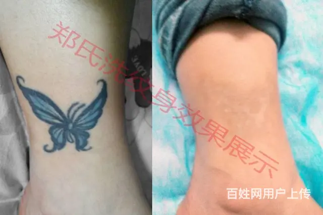 纹身洗不掉就到辽阳郑氏洗纹身专洗别处洗不掉所有纹身 - 图片 9