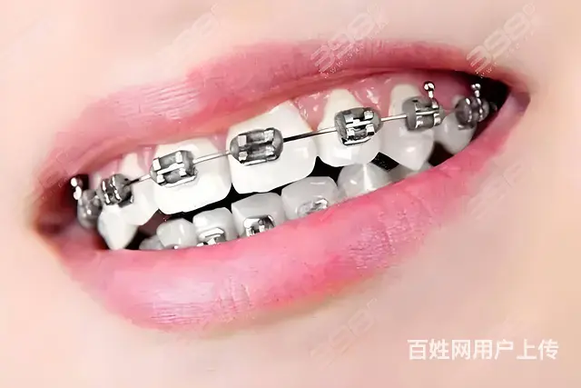 矫正后牙齿反弹不再困扰，这些方法帮你维持美丽笑容 - 图片 3