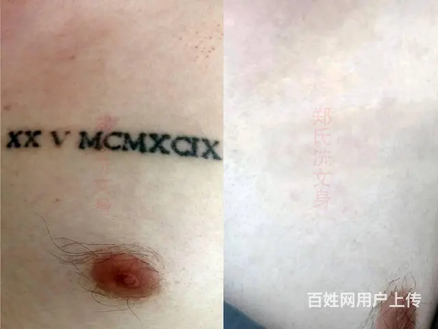 洗纹身怎么彻底洗掉需要多少钱 - 图片 7