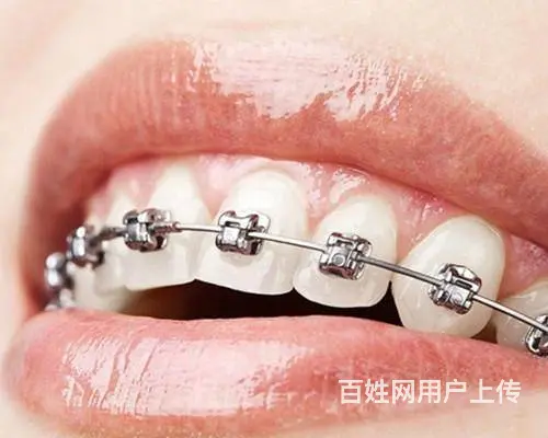 哈尔滨牙齿矫正多少钱 - 图片 2