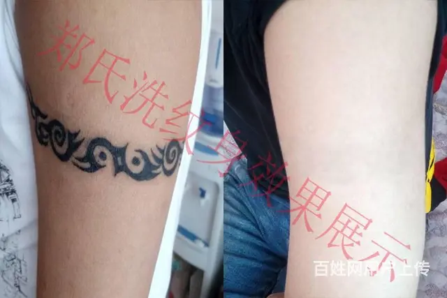 沈阳洗纹身一次洗净纹身郑氏洗纹身签合同包洗干净纹身 - 图片 4