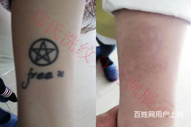 沈阳洗纹身一次洗净纹身郑氏洗纹身签合同包洗所有纹身 - 图片 10
