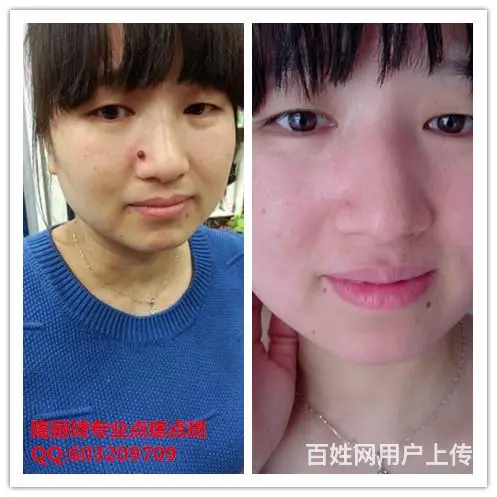 徐州专业点痣点斑祛痘隆丽琦诚招代理加盟 - 图片 2
