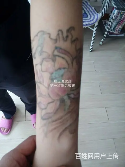小女生洗纹身失败再纹身遮盖 后彻底洗掉纹身 - 图片 2