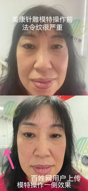 厦门一根针灸美雕技术 效果才是王道 - 图片 1