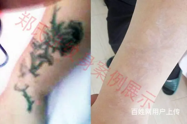 纹身洗不掉就到辽阳郑氏洗纹身专洗别处洗不掉所有纹身 - 图片 12