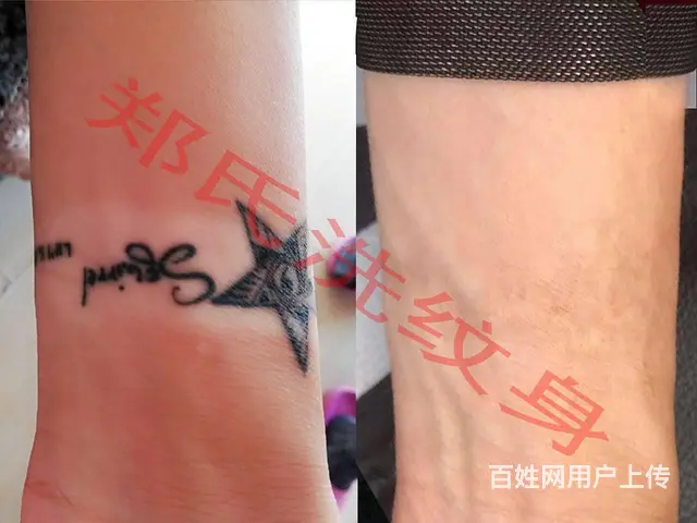 抚顺洗纹身哪家好辽阳郑氏洗纹身包洗干净真可靠 - 图片 5