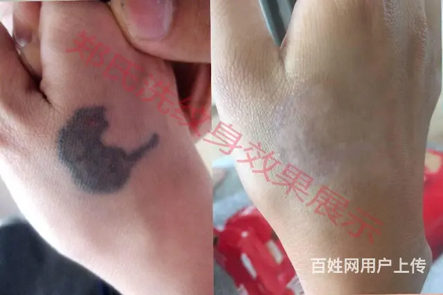 纹身洗不掉就到辽阳郑氏洗纹身专洗别处洗不掉所有纹身 - 图片 3