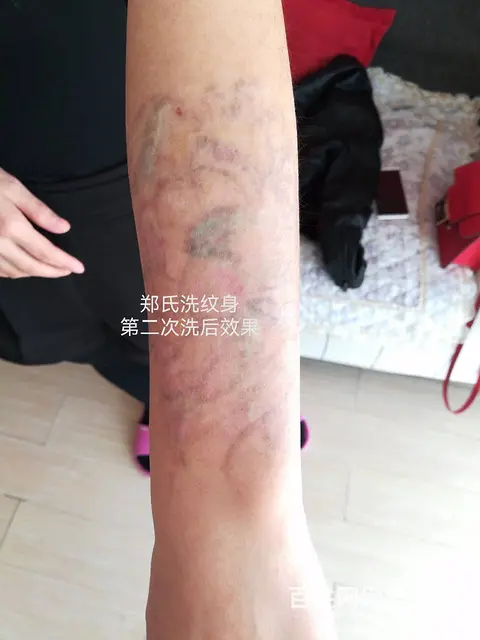 小女生洗纹身失败再纹身遮盖 后彻底洗掉纹身 - 图片 3
