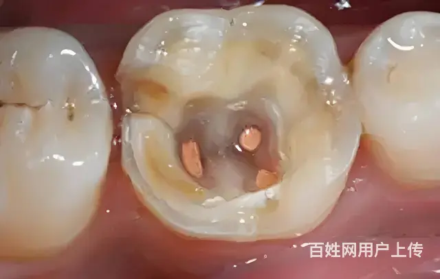 根管  应该注意什么 - 图片 1