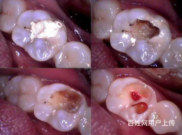根管  应该注意什么 - 图片 2