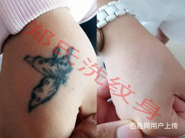 抚顺洗纹身洗不掉就到辽阳郑氏洗纹身 - 图片 6