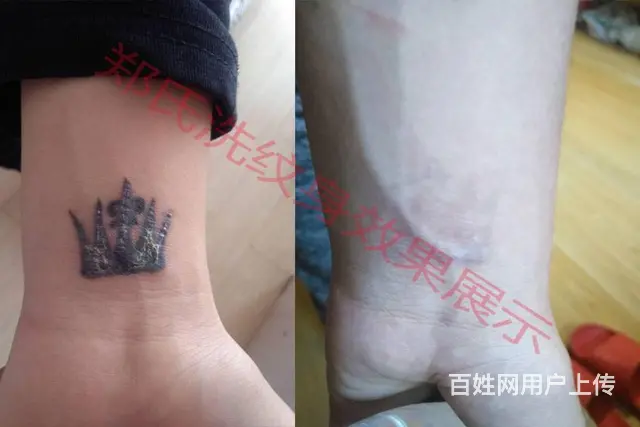 洗纹身就到辽阳郑氏洗纹身专洗别处洗不掉的所有纹身 - 图片 11