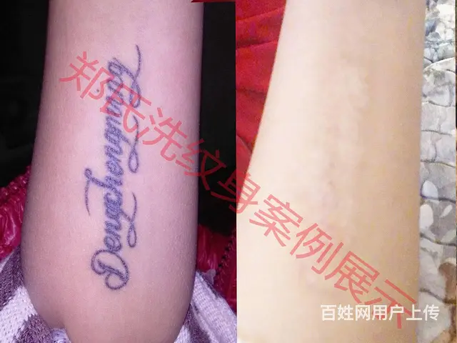 沈阳洗纹身一次洗净纹身郑氏洗纹身包洗干净所有纹身 - 图片 12