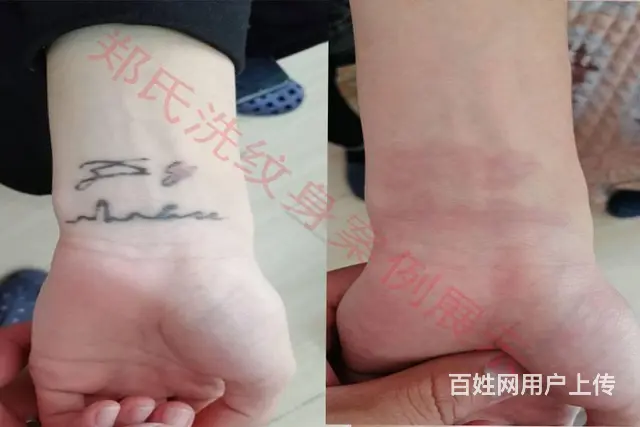 纹身洗不掉就到辽阳郑氏洗纹身专洗别处洗不掉所有纹身 - 图片 11
