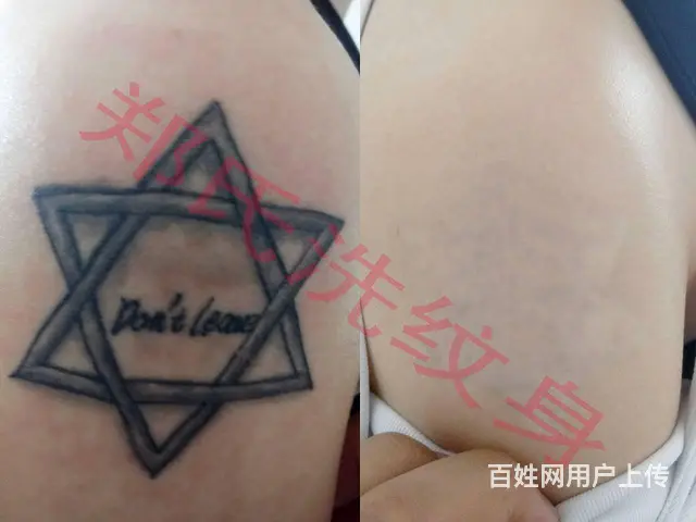 洗纹身洗不掉就到辽阳郑氏洗纹身 - 图片 9