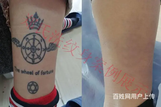 洗纹身哪家好辽阳郑氏洗纹身专业技术签合同包洗效果好 - 图片 3
