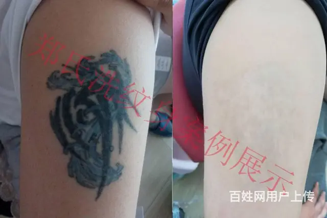 沈阳洗纹身一次性洗纹身签合同包洗所有纹身郑氏洗纹身 - 图片 11