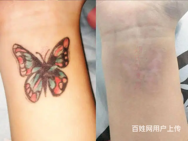 郑氏洗纹身工作室20年专注洗纹身 - 图片 9