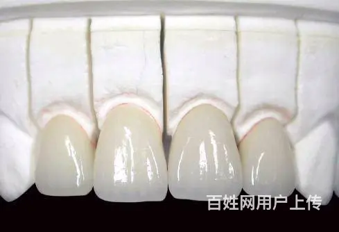 哈尔滨种植牙不同材料有哪些 - 图片 2
