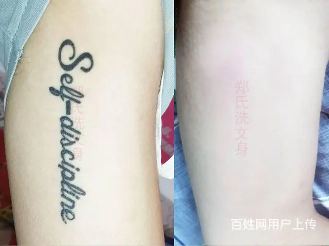 洗纹身怎么彻底洗掉需要多少钱 - 图片 1