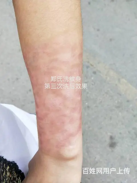 小女生洗纹身失败再纹身遮盖 后彻底洗掉纹身 - 图片 4