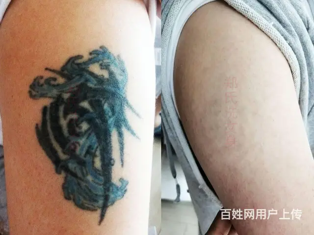 纹身全部洗掉常有几种方​‌‌​‌‌法可以选择 - 图片 2