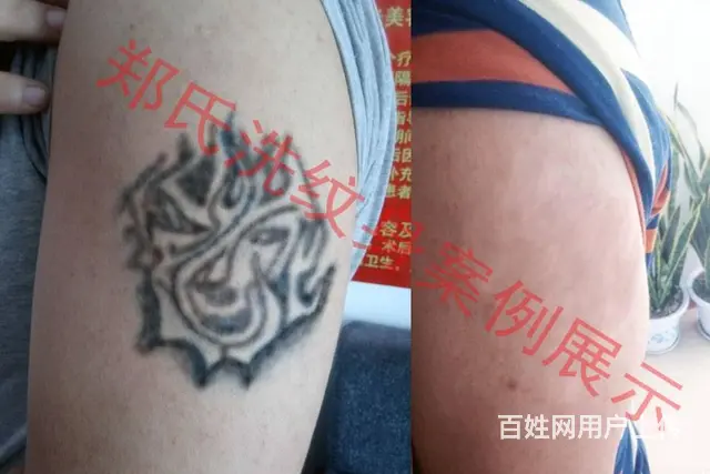 沈阳洗纹身一次洗净纹身郑氏洗纹身签合同包洗所有纹身 - 图片 5