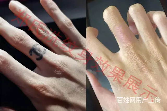沈阳洗纹身一次洗净纹身郑氏洗纹身签合同包洗干净纹身 - 图片 11