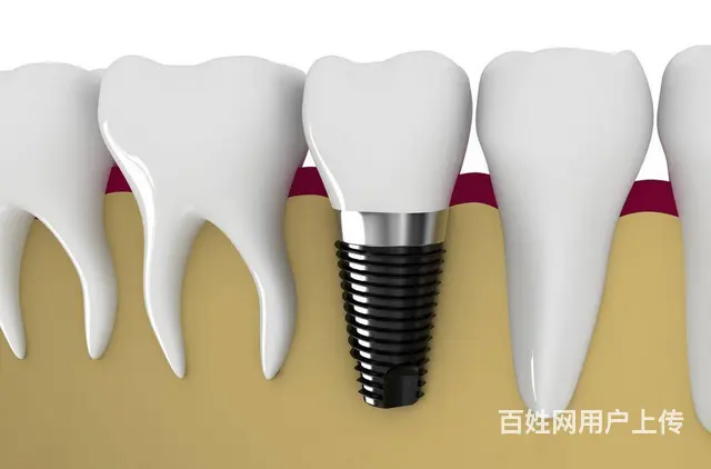 想换新牙？看这里！哈尔滨进口种植牙费用一览无余 - 图片 1