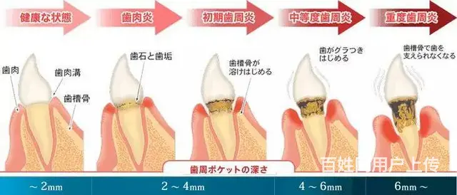 牙齿的隐形杀手：了解牙周炎与牙髓炎的秘密差异 - 图片 2